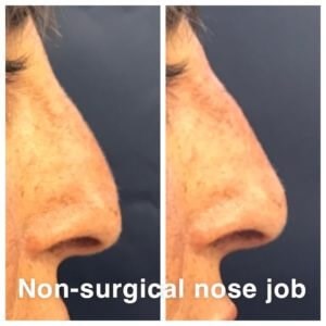 Nose Job